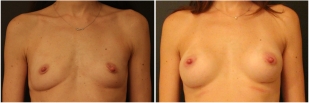 breast-implants-before-and-after-photo-10