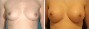 breast-implants-before-and-after-photo-13-1