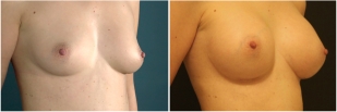 breast-implants-before-and-after-photo-13-2