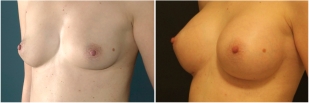breast-implants-before-and-after-photo-13-3