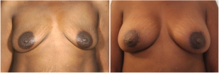 breast-implants-before-and-after-photo-14