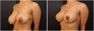 breast-lift-before-and-after-photo-10-2
