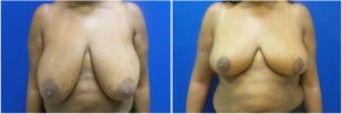breast-lift-before-and-after-photo-11-1