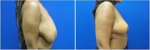 breast-lift-before-and-after-photo-11-2
