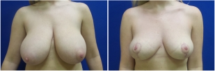 breast-lift-before-and-after-photo-12-1