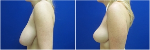 breast-lift-before-and-after-photo-12-2