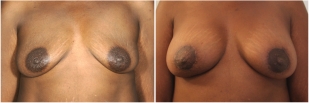 breast-lift-before-and-after-photo-13