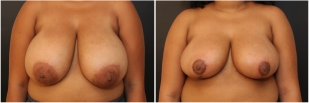 breast-lift-before-and-after-photo-14-1