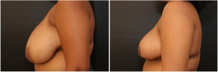breast-lift-before-and-after-photo-14-2