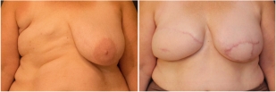 breast-reconstruction-flap-before-and-after-photo-10