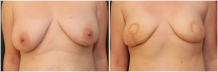 breast-reconstruction-flap-before-and-after-photo-12