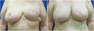 breast-reconstruction-flap-before-and-after-photo-13-1