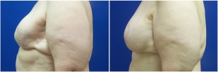 breast-reconstruction-flap-before-and-after-photo-13-2