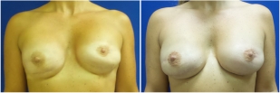breast-reconstruction-revision-before-after-photo-10