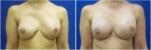 breast-reconstruction-revision-before-after-photo-11