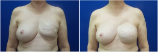 breast-reconstruction-revision-before-after-photo-12-1