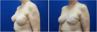 breast-reconstruction-revision-before-after-photo-12-2