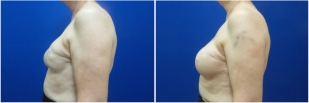 breast-reconstruction-revision-before-after-photo-12-3