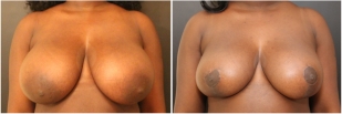 breast-reduction-before-after-photo-11