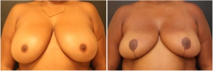 breast-reduction-before-after-photo-13-1