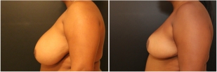 breast-reduction-before-after-photo-13-2