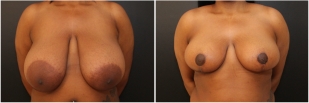 breast-reduction-before-after-photo-14-1