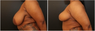breast-reduction-before-after-photo-14-2