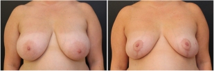 breast-reduction-before-after-photo-15-1