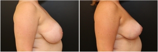 breast-reduction-before-after-photo-15-2