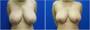 breast-reduction-before-after-photo-16