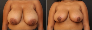 breast-reduction-before-after-photo-17-1