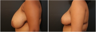 breast-reduction-before-after-photo-17-2