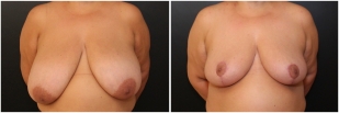 breast-reduction-before-after-photo-18-1