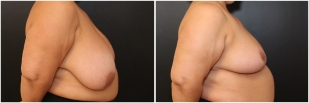 breast-reduction-before-after-photo-18-2