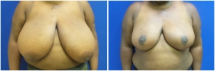 breast-reduction-before-after-photo-19-1