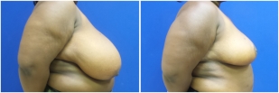 breast-reduction-before-after-photo-19-2