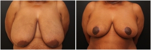 breast-reduction-before-after-photo-20-1