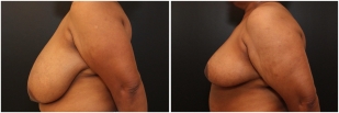 breast-reduction-before-after-photo-20-2