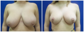 breast-reduction-before-after-photo-21-1