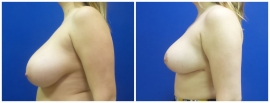 breast-reduction-before-after-photo-21-2
