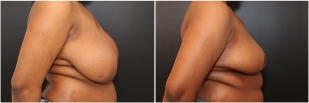 breast-reduction-before-after-photo-22-1