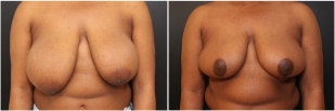 breast-reduction-before-after-photo-22-2