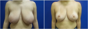 breast-reduction-before-after-photo-23-1