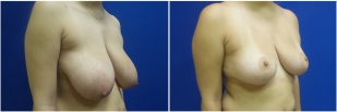 breast-reduction-before-after-photo-23-2