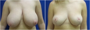 breast-reduction-before-after-photo-24-1