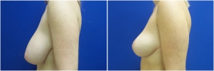 breast-reduction-before-after-photo-24-2