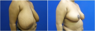 breast-reduction-before-after-photo-25