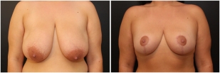 breast-reduction-before-after-photo-26-1