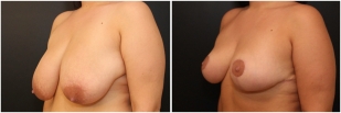 breast-reduction-before-after-photo-26-2