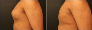 gynecomastia-before-after-and-after-photo-10-2
